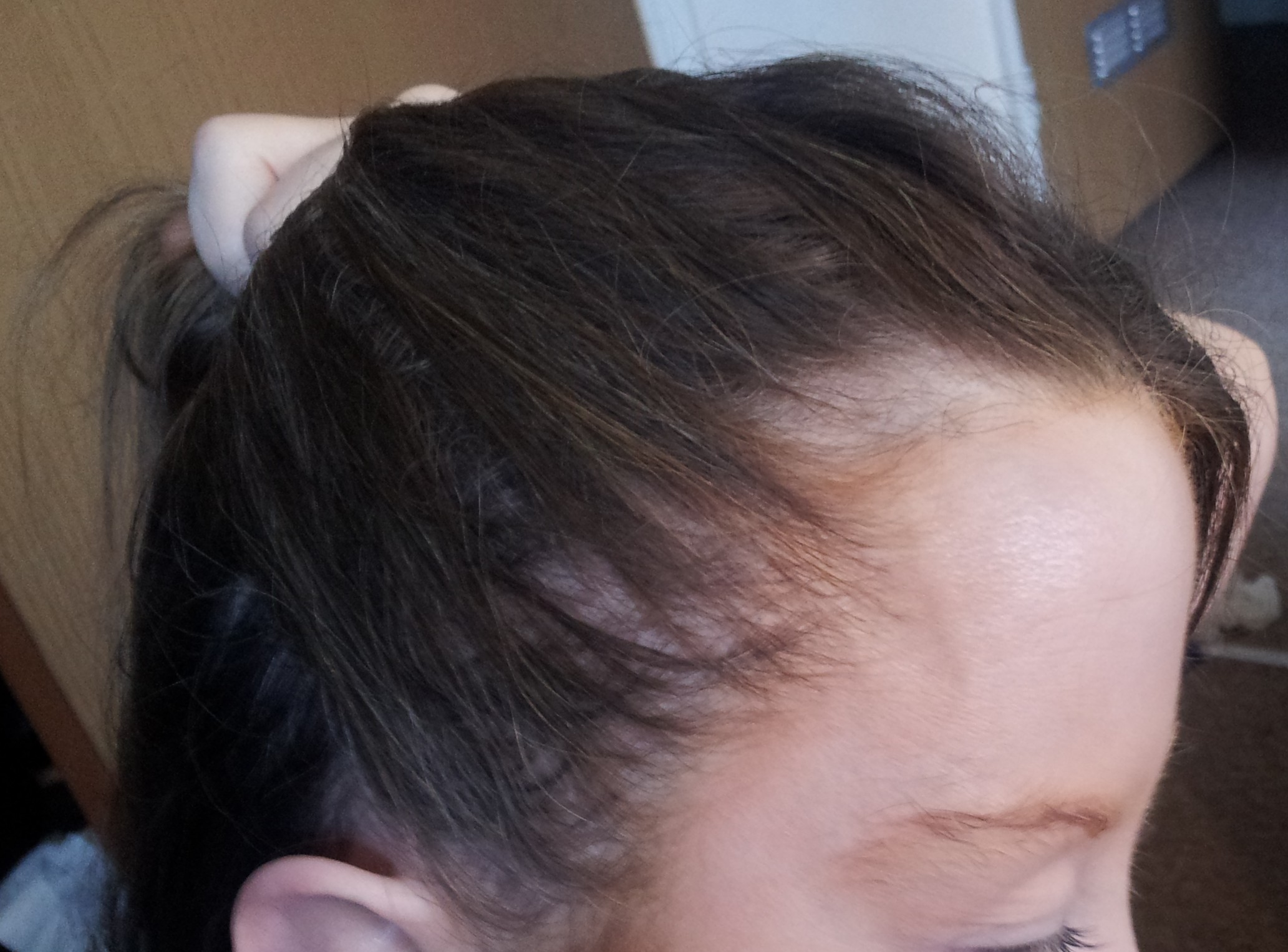 Фото выпавших волос. Андрогенная алопеция алопеция. Очаговая алопеция (alopecia Areata). Андрогенная алопеция у женщин.